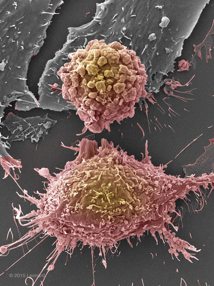 Breast Cancer Cells (BT549 Triple Negative)