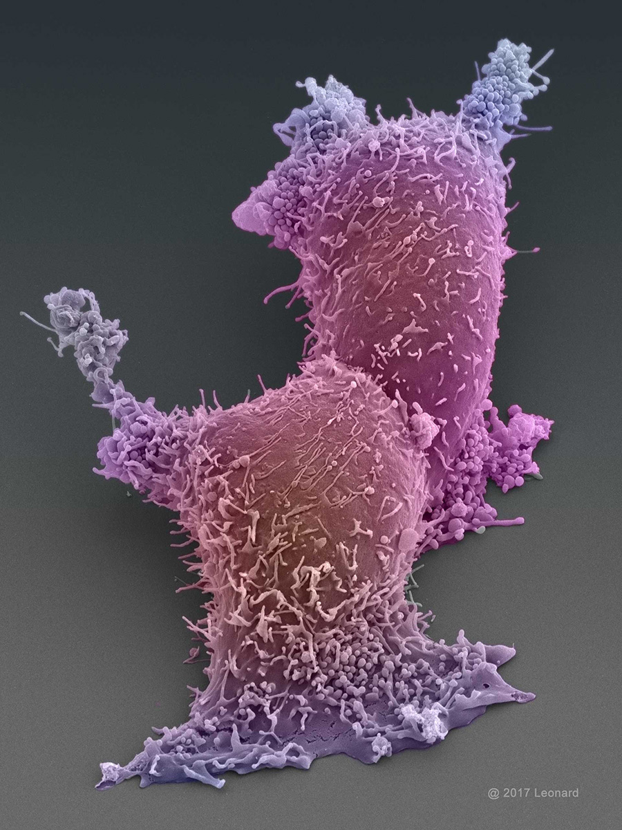 Prostate Cancer Cells (trying to hitch a ride)