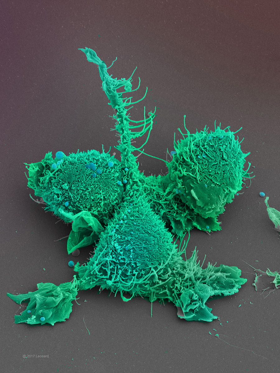 Prostate Cancer Cells with crazy various morphology