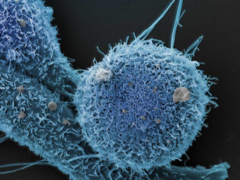 Prostate Cancer Cells, Not Italy, 