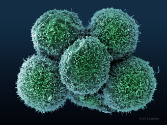 Cluster of at least six HER2 breast cancer cells. They look like Dunkin' munchkins.